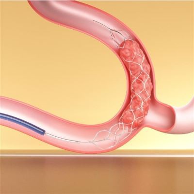 Stent Retriever Menyikat dengan Kateter Aspirasi